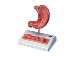 STOMACH WITH ULCERS - K17  1000304 