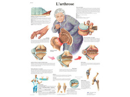 POSTER L ARTHROSE - FRANCAIS - VR2123L