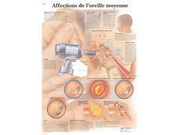 POSTER AFFECTIONS DE L OREILLE MOYENNE - VR2252L