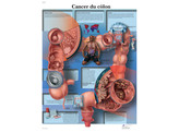 POSTER CANCER DU COLON - VR2432L