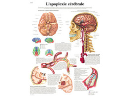 POSTER  L APOPLEXIE CEREBRALE - VR2627L