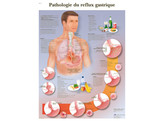 POSTER PATHOLOGIE DU REFLUX GASTRIQUE - VR2711L